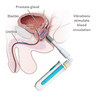 prostatitis massage treatment