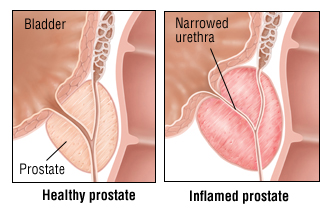 Augmentin prostata