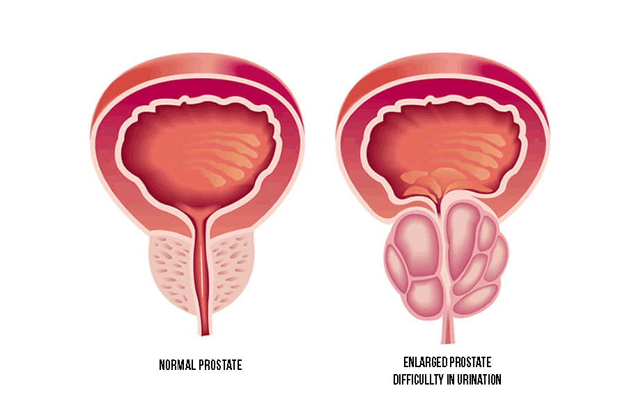 prostate-infection-natural-treatment-prostate-health-center