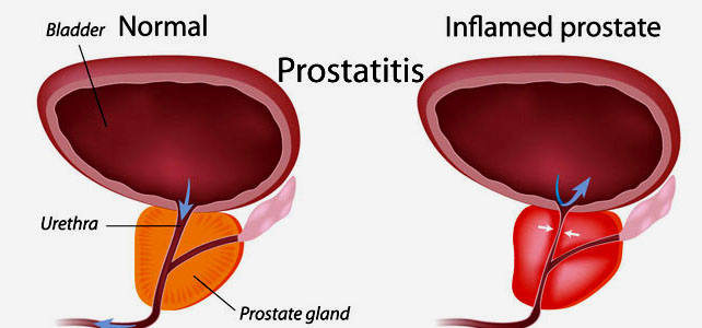 Inflamed Prostate