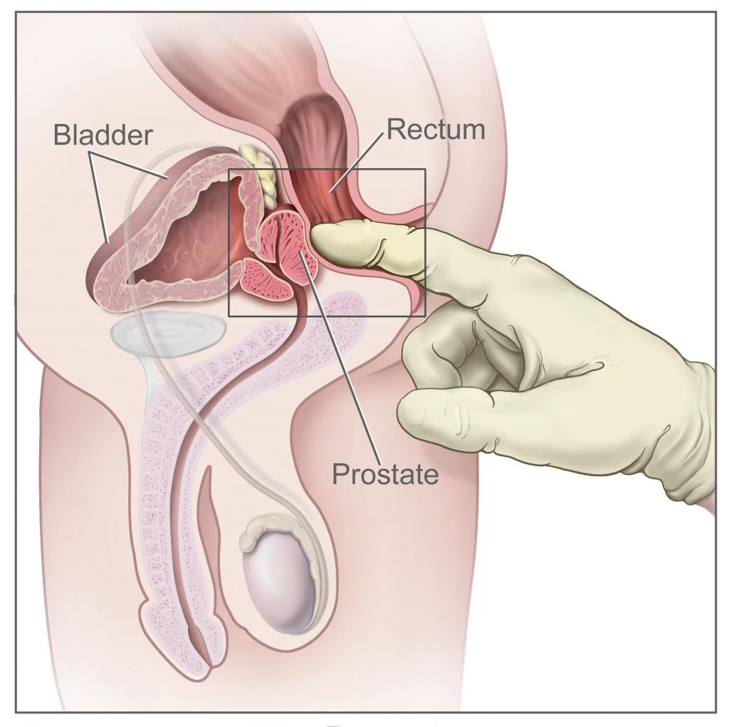 Image of prostate massage