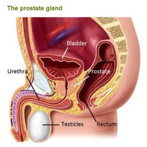 Zapalenie prostaty (gruczołu krokowego) - objawy, leczenie