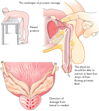 Simptome frecvente în cancerul de prostată - când mergem la medic?